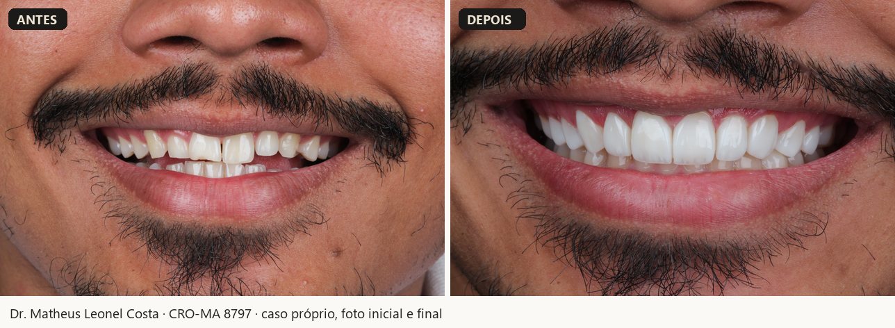 Antes e depois de facetas em resina, caso 02